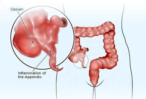 الزائدة الدودية